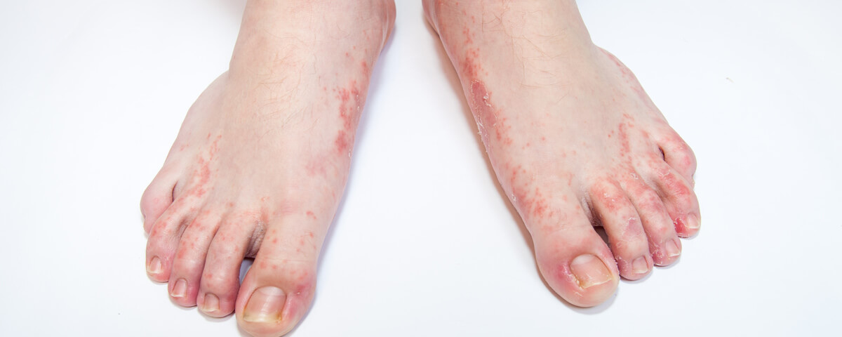 Dermatomicose (fungos da pele)