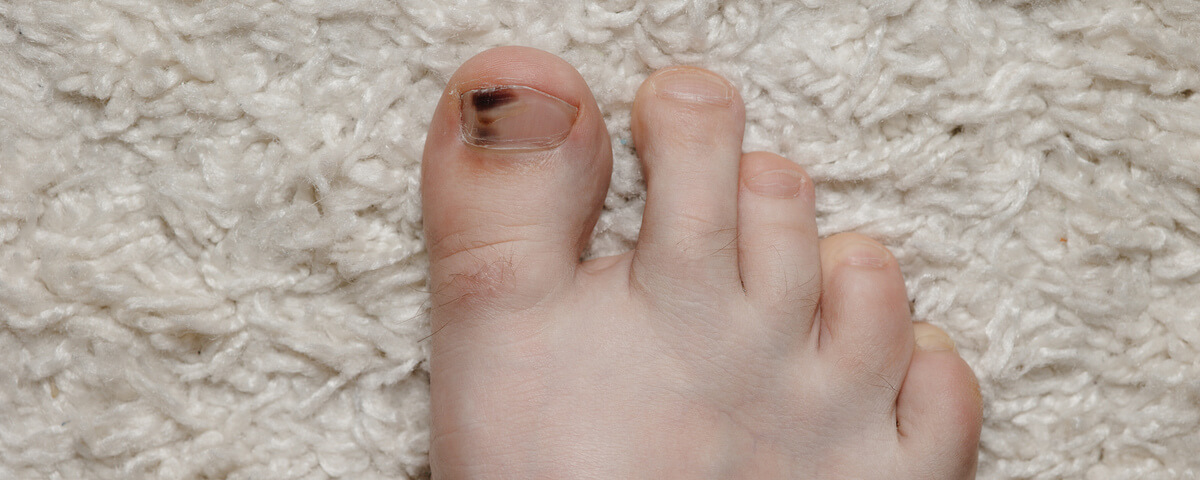 Hematoma subungueal (sangue por debaixo das unhas)