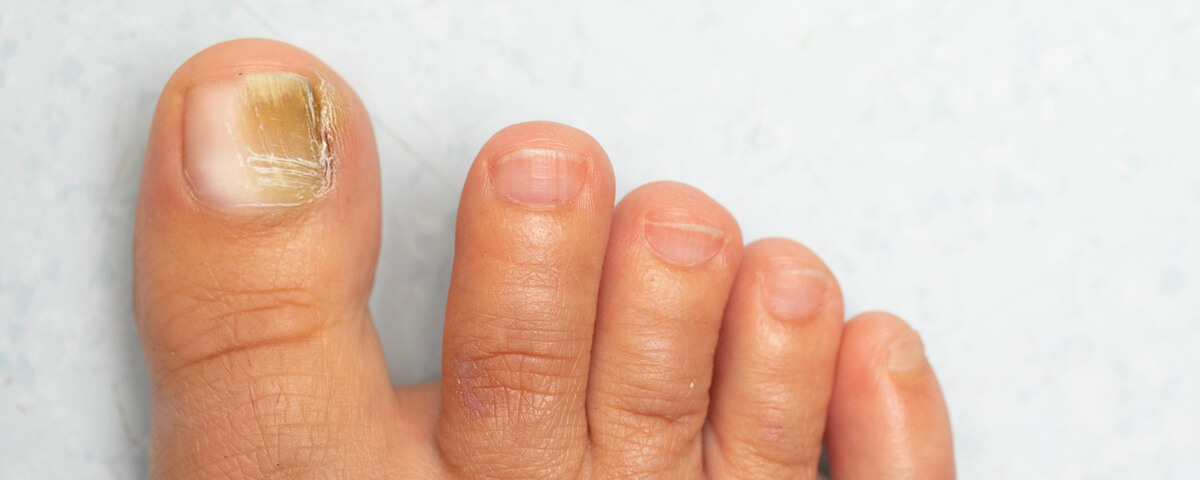 Onicomicoses (fungos nas unhas)