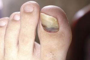 Hematoma subungual (blood beneath the nails) - PodoSaúde Clinic