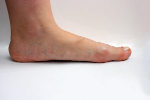 Flat Foot PodoSaúde Clinic